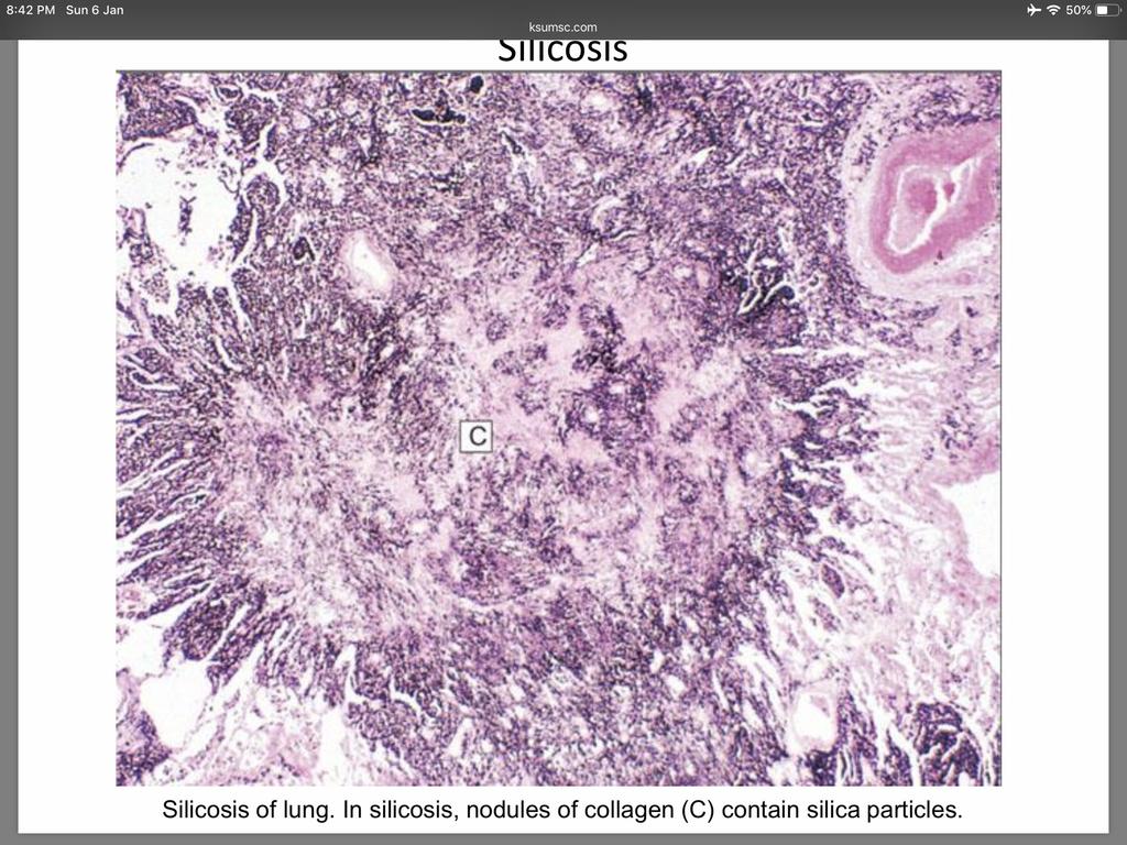 Note the dense pleural thickening concentrically arranged hyalinized collagen fibers surrounding an amorphous center.