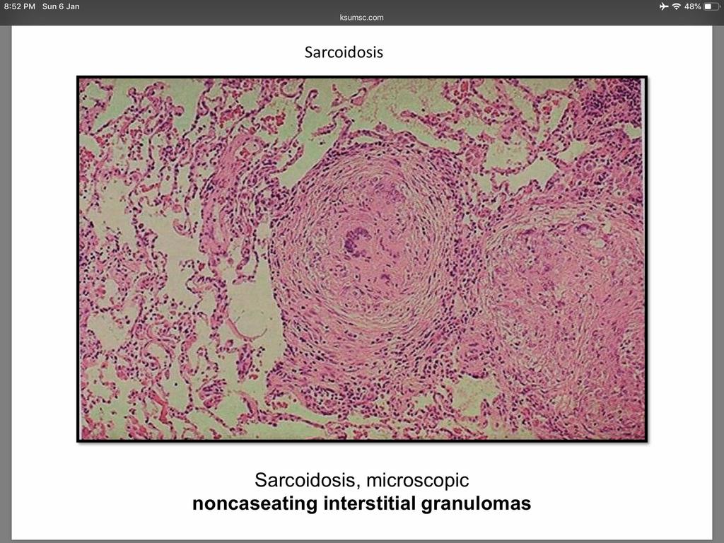 Granulomatous diseases 1- Sarcoidosis Definition Immunological multisystem disease of unknown