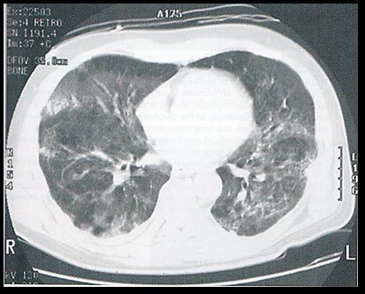 Acute restrictive lung diseases (INTRINSIC TYPE) 1- Acute Respiratory