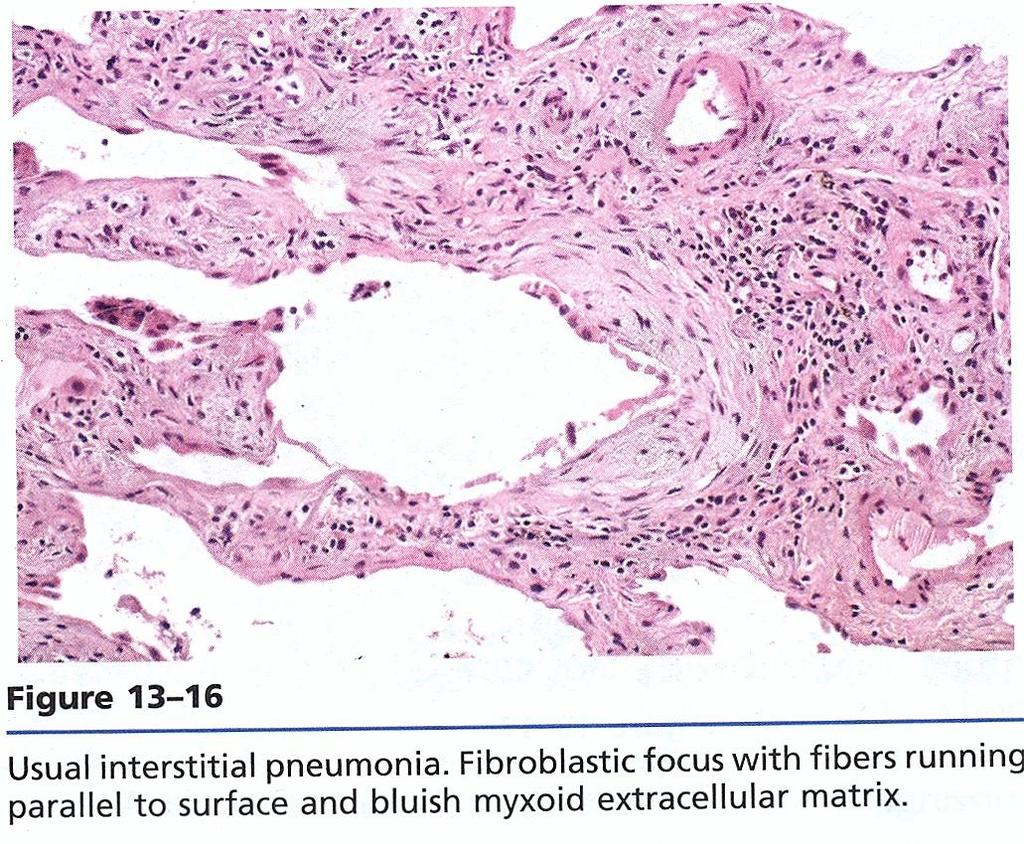 Advanced: Morphology Gross: Microscopic: Interstitial fibrosis Honeycomb change, Fibrosis in