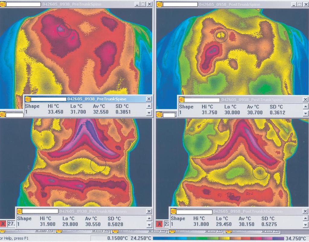 The upper images recorded the thermal reading of the upper back of a subject with a specific thermal pattern noted in the left upper thoracic paraspinal region.