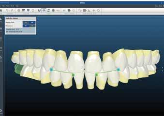 1 Expert tip: When setting up the case, use the control key to rotate the digital occlusal plane to match the patient s natural occlusal plane.