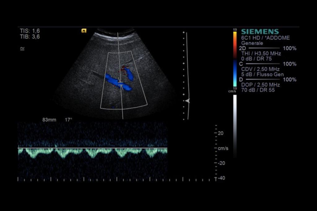 Fig. 10: Example of middle hepatic vein Doppler imaging conducted during a normal US liver evaluation; in the