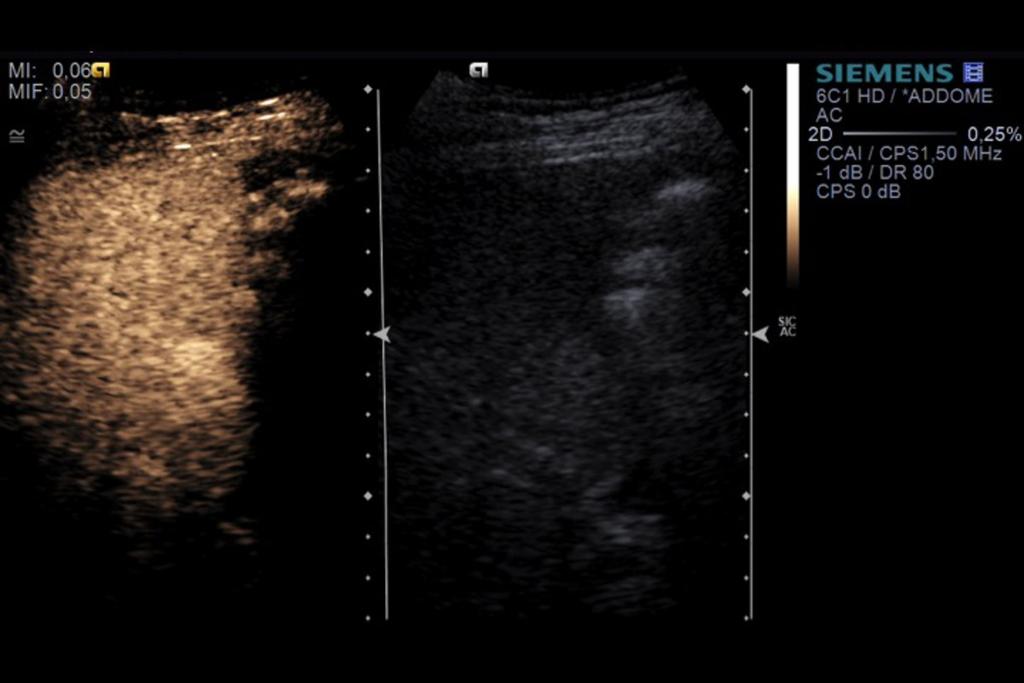 Fig. 11: Example of contrast enhanced ultrasonography (CEUS) of an hepatic nodular lesion conducted during a normal US liver