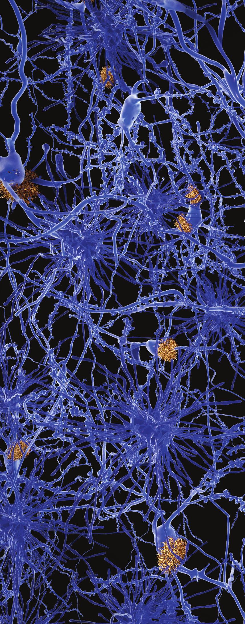 Join Us Alzheimer s disease: neuron network with amyloid plaques At Stanford Medicine, we are getting closer every day to building a complete picture of Alzheimer s disease and other forms of