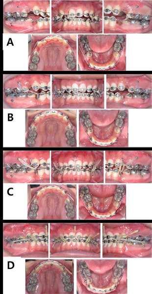A New Protocol of Tweed-Merrifield Directional Force Technology Using Micro-Implant Anchorage (M.I.A.) http://dx.doi.org/10.5772/60106 207 Figure 20. A. Denture preparation: retraction of the maxillary and mandibular canines to level six anterior teeth.