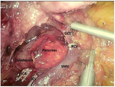 Page 18 of 18 FIGURES Fig. 1 Intraoperative photograph shows the dissected out superior mesenteric vein (SMV) with the ligated ileocolic vein (ICV) and ileocolic artery (ICA).