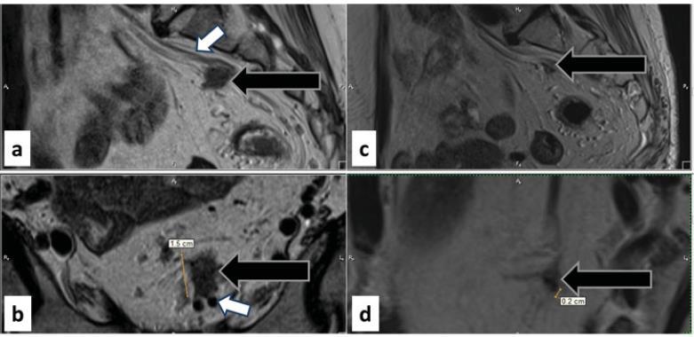 DISCONTINUOUS VASCULAR SPREAD SEEN USING MREMVI Vascular invasion is manifest on MRI as either direct spread from the primary tumour into an adjacent extramural vessel or as discontinuous seeding