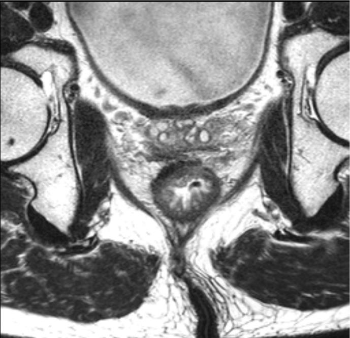 Post treatment, the intermediate (grey) signal of tumour has been replaced by fibrotic (black) signal with fibrosis involving the rectal wall and normal fat