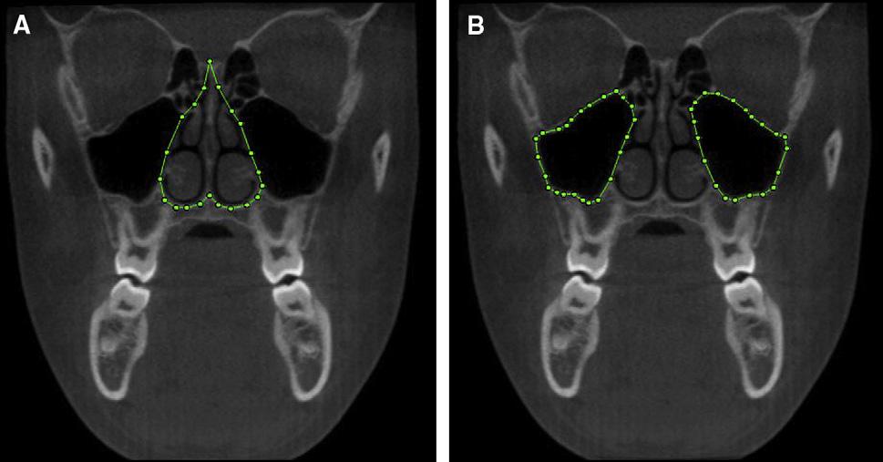 Smith et al 621 Fig 3. Coronal outline of the boundaries of: A, the nasal cavity; and B, the maxillary sinuses.