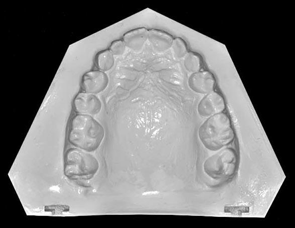 Obtain normal overjet and overbite. 4.