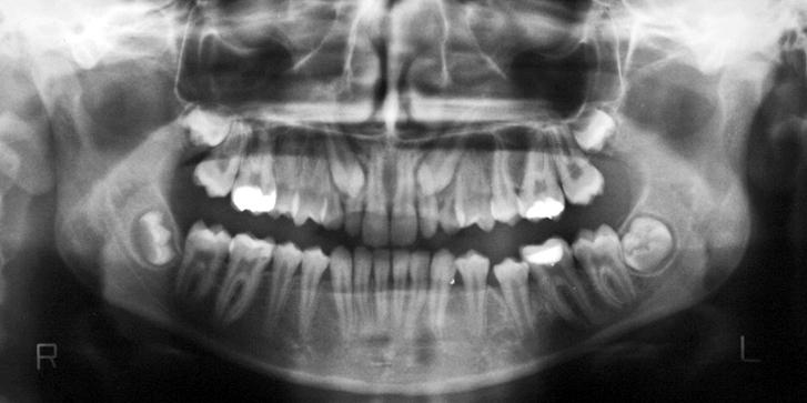 impacted maxillary canines and distalization of upper