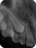 closure of the extraction space orthodontically; (3)