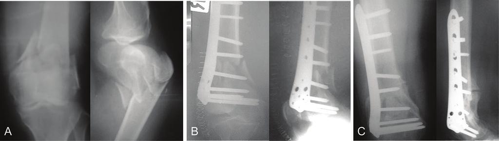 4 Distal femoral fracture (C3, AO classification): (A) Initial injury, (B) Postoperative plain radiograph, (C) Follow-up at 12 months.
