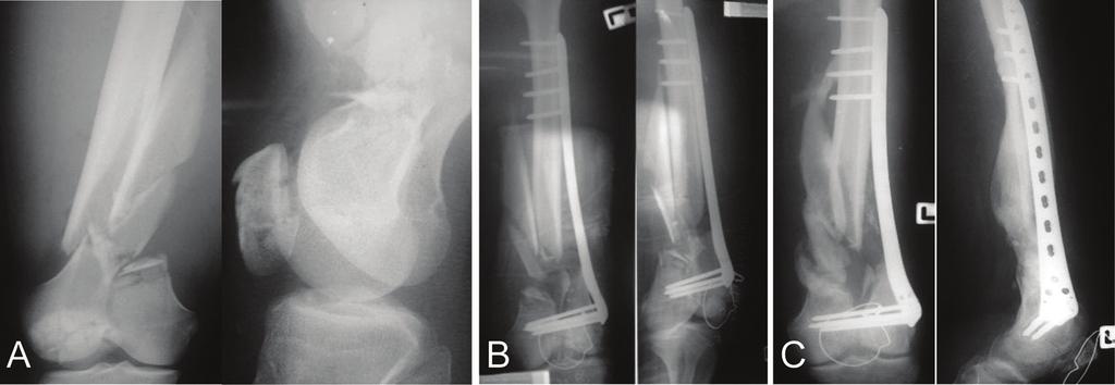 Implant failure occurring early (less than 3 months post op) was most often the result of mechanical instability secondary to either the surgical technique or the implant design, while implant