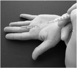 common Tenderness to palpation over involved MCP and/or A1 pulley Palpable click with passive/active finger extension/flexion Swelling over area Mainly clinical diagnosis X rays of hand may show MCP