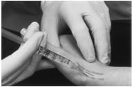 Management of De Quervain s Tenosynovitis Activity modification Splinting (thumb spica) NSAIDs Steroid Injection 83% of cases cured after one steroid