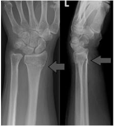 5 cc steroid 20 mg Triamcinolone Thumb extension to visualize tendons Inject into first dorsal compartment at level of wrist crease #7 Question A 65 year