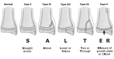 #6 Question What is the most common type of finger dislocation? 1. Dorsal Dislocation at First MCP 2. Dorsal Dislocation at PIP 3. Volar Dislocation at PIP 4. Volar Dislocation at DIP 5.