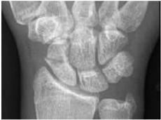 Diagnosis of Scaphoid Fracture FOOSH Radial sided wrist pain after trauma Often without deformity or swelling ROM often intact Tenderness in the anatomical snuffbox and/or distal to the dorsal radial