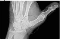 #3 Question A 78 year old male presents to your office with right wrist pain. He states the pain is worse over the radial side of his wrist.