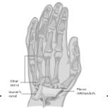 Scapholunate, Radial/carpal Grind test X rays usually definitive with high clinical suspicion Management of Hand/Wrist Arthritis Braces Wrist Thumb NSAIDS (topical/oral) Steroid Injection 20mg 40mg