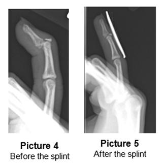 1. Finger Sprain 2. Distal Phalanx Fracture 3. Jersey Finger 4. Mallet Finger 5.