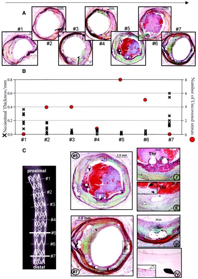 Heterogeneity of neointimal healing after DES placement and the impact on late stent thrombosis DES Thrombosis (n=28) No DES Thrombosis (n=34) Fibrin score 2.4±1.3 1.2±1.1 0.