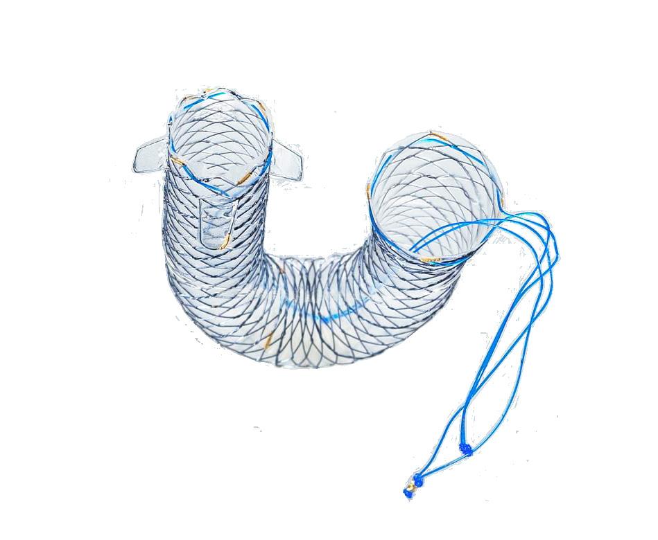 The Stent... The Stent... Features and Benefits: Nitinol Wire: Hanarostent is hand weaved using nitinol (nickel titanium alloy). The nitinol mesh provides flexibility and excellent radial force.