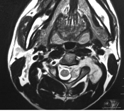 Axial T2-weighted MRI of the spine reveals a dumbbell shaped soft-tissue mass compressing the spinal cord and left nerve root. MRI, magnetic resonance imaging. Figure 6. Case 3.