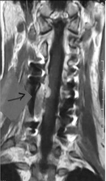 724 ZHU et al: PRIMARY DUMBBELL-SHAPED EWING'S SARCOMA OF THE CERVICAL VERTEBRA IN ADULTS Figure 7. Case 4.