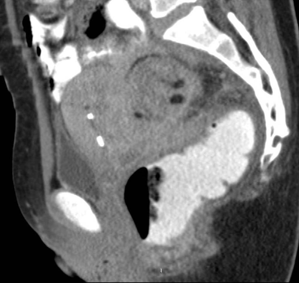 Fig. 3: Figures 3-4: CT images after administration of rectal contrast: bowel