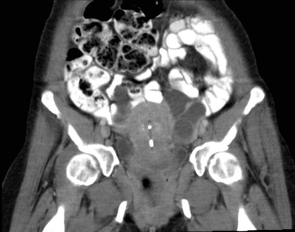 Fig. 4: Figures 3-4: CT images after administration of rectal contrast: bowel