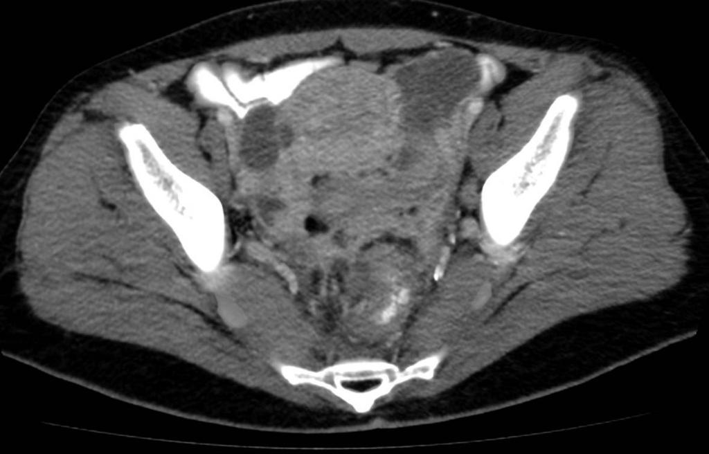 Fig. 5: Figures 5-6: Many "cystic" lesions consistent with abscesses are seen in the pelvic area,