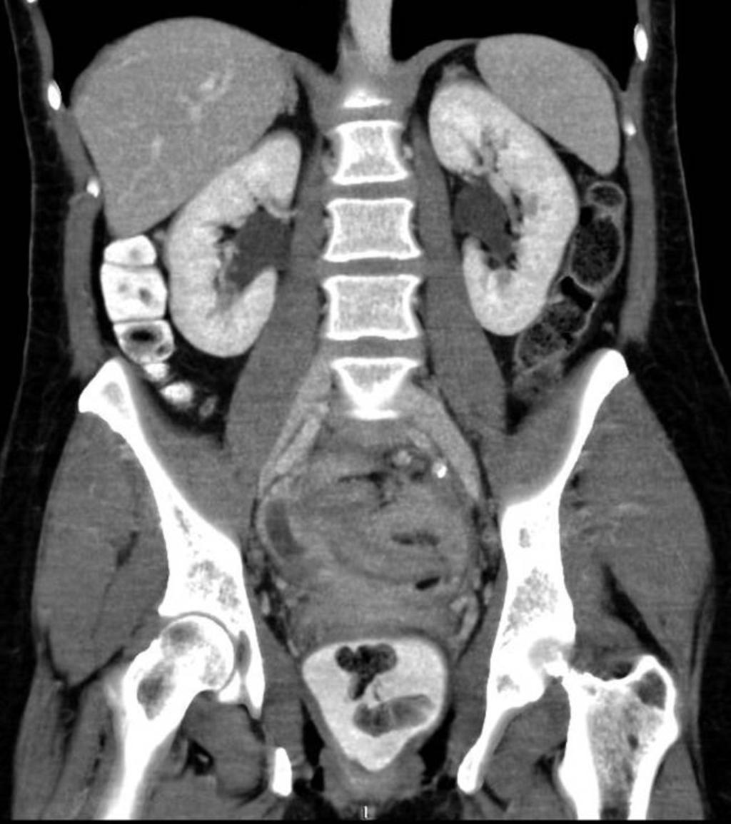 Fig. 6: Figures 5-6: Many "cystic" lesions consistent with abscesses are seen in the pelvic area,