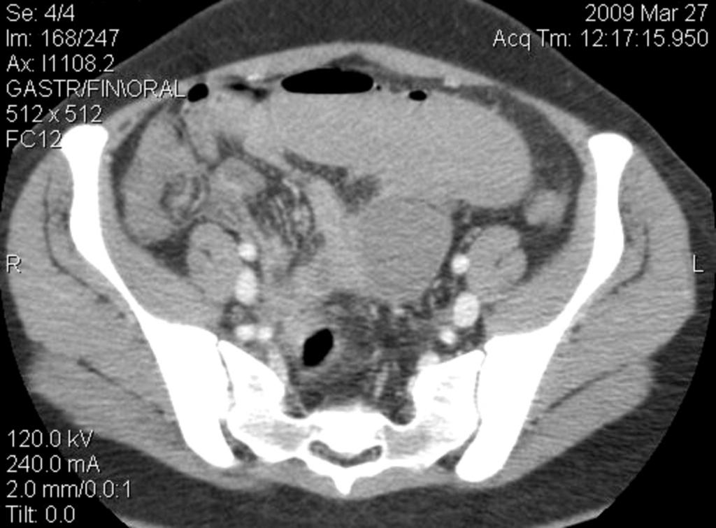 Fig. 7: Figures 7-8-9: Many abscesses are evident on these CT images involving the pericecal and pelvic area, while there