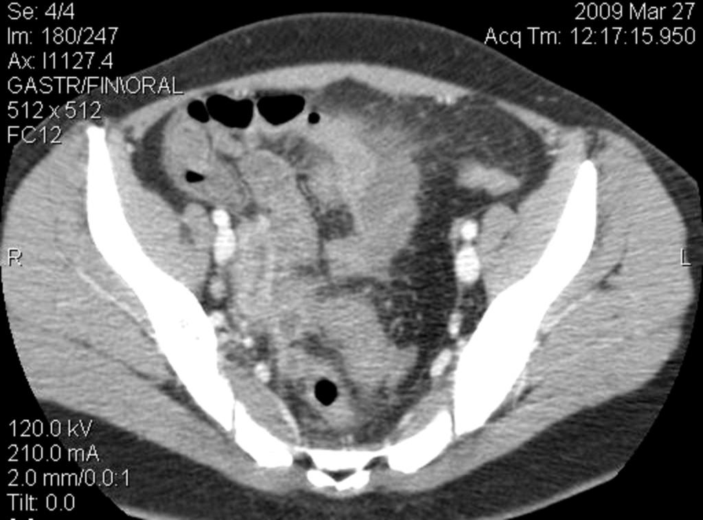 Fig. 8: Figures 7-8-9: Many abscesses are evident on these CT images involving the pericecal and pelvic area, while there