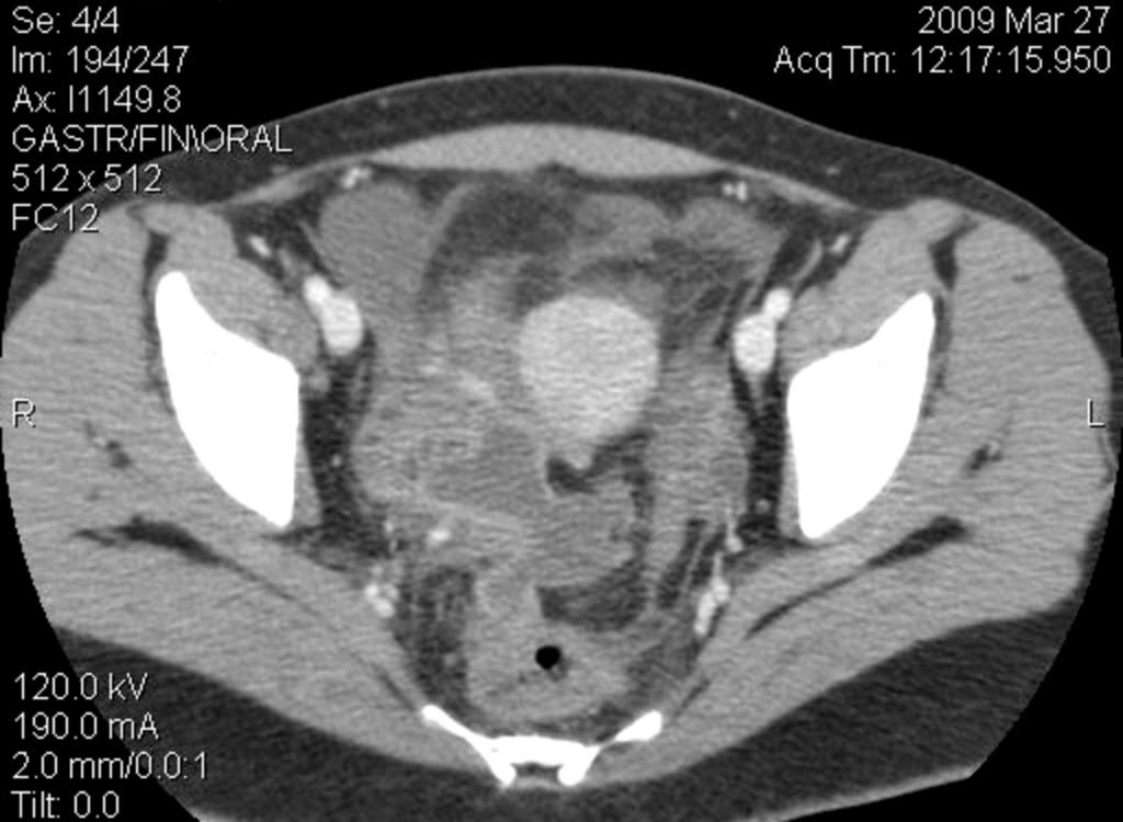 Fig. 9: Figures 7-8-9: Many abscesses are evident on these CT images involving the pericecal and pelvic area, while there