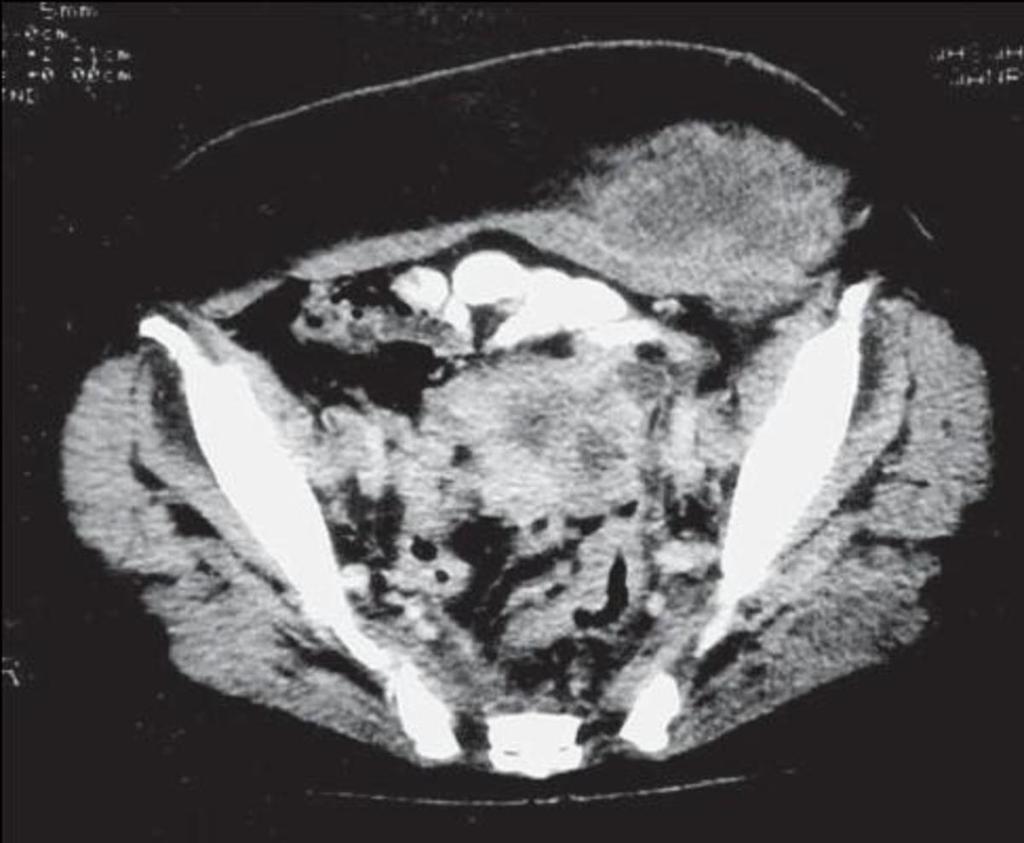 Fig. 10: CT image shows a very large abscess of the left lateral abdominal wall, as well as many