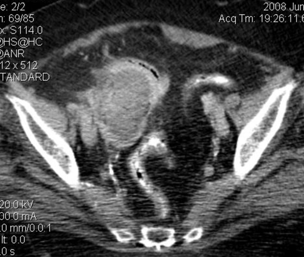 Fig. 11: A mass-like heterogenous large lesion is shown in the right pelvis