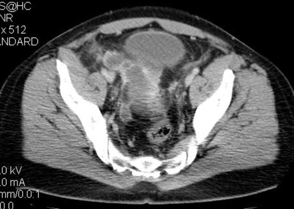 Fig. 12: Abdominal CT image: many abscesses are evident in the right pelvis, while