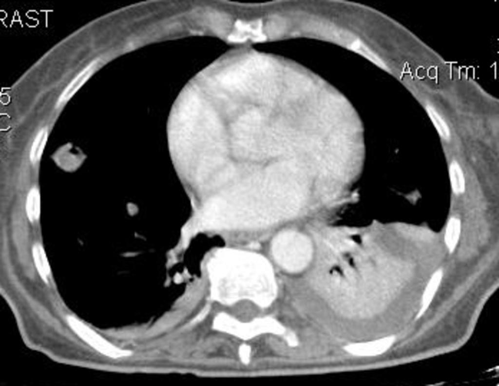 Fig. 13: Thoracic CT image: a small abscess is seen in the right upper lobe and atelectasis in