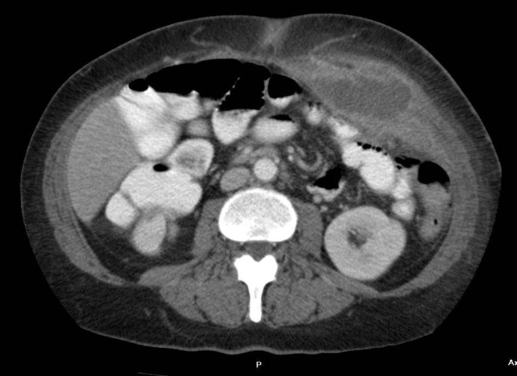 Fig. 16: A large left lateral abdominal wall abscess is