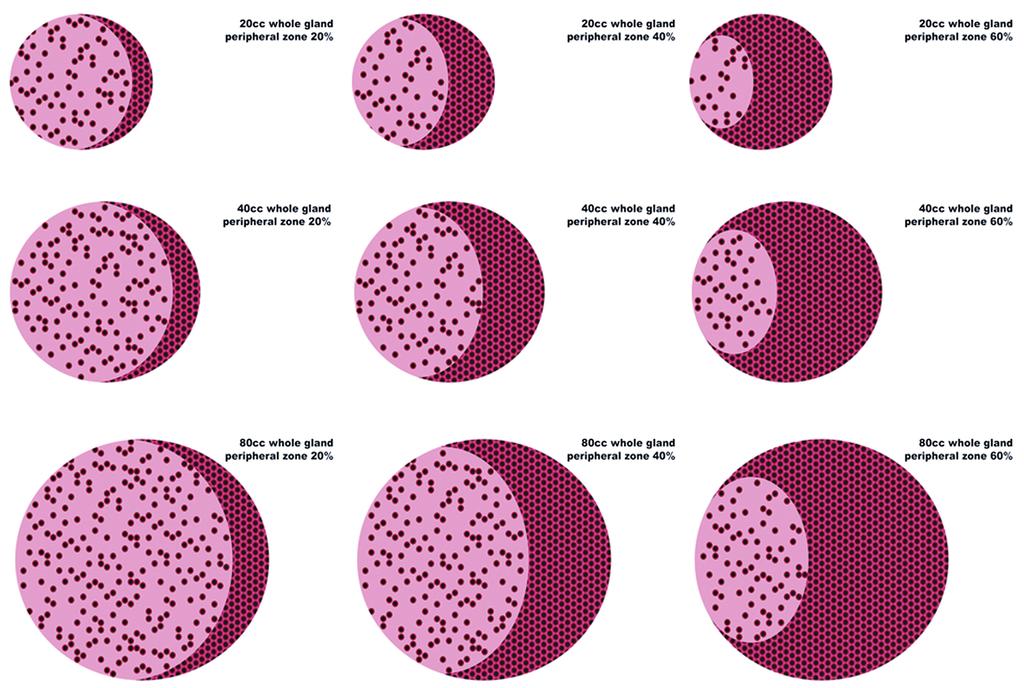 ibju PSA and Acinar Density: The Prostatocrit Figure 1 - Normal gland 20cc schematic diagram. 70% PZ by volume 30% TZ by volume. PZ 80% acini 20% stroma (cells red, lumen black, stroma pink).