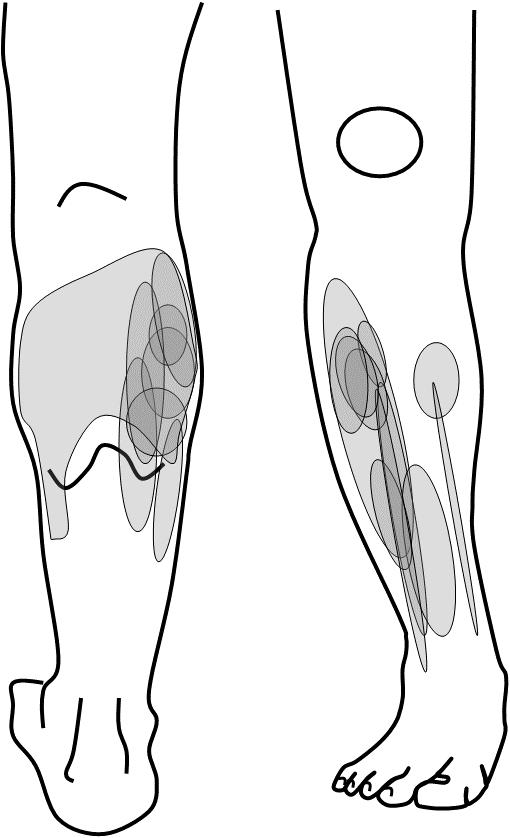 Pain and the H-reflex Figure 21: Area of pain during hypertonic saline (pain) trials Subjects were asked to represent the area of pain experienced during the trials on a figure similar to that shown.