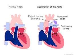 aorta Renal disease
