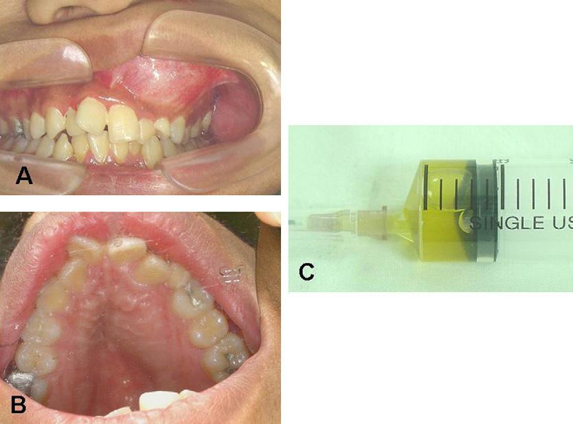 258 Y.-K. Chen et al. canine and rarely the permanent molars as well as the deciduous teeth.
