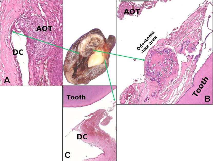 AOT arising from a dentigerous cyst 261 Fig.