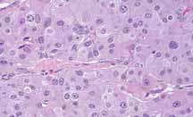 However, while the primary duodenal ECA tissue was negative for SSTR-1, the metastatic ECA in the