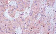 Conversely, moderate (2+) IHC expression of SSTR-3 in the primary duodenal ECA was found to be lost